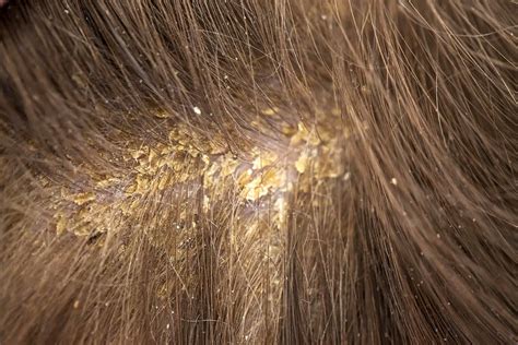 Dandruff can be controlled, but there's no way to completely get rid of it. Oily Yellow Dandruff | Head & Shoulders