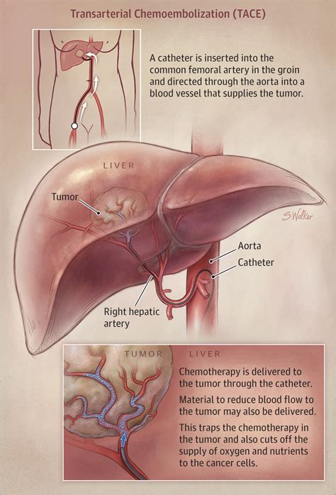 Transarterial Chemoembolization Emergency Nursing Diagnostic Medical Sonography Medical Anatomy