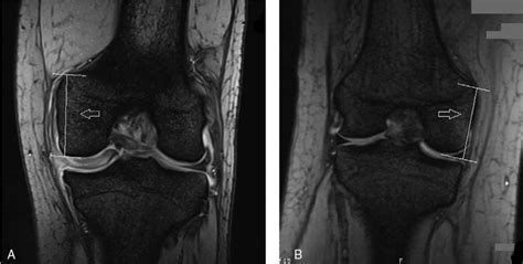 Mri Image Of The Patient A Left Knee And A Normal Knee B Right