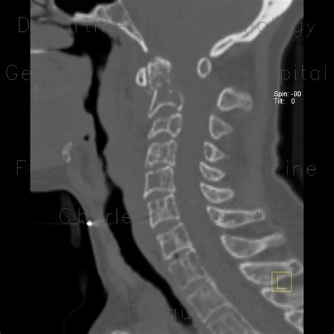 Radiology Case Osteolytic Metastasis Of Cervical Spine Fracture Of