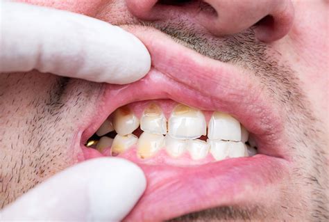 Top 5 Ways To Ruin Your Enamel Advantage Dental Group
