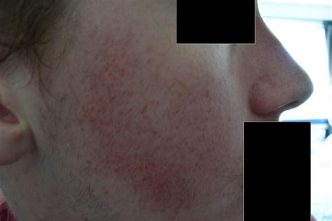 Skin Concerns Red Blotchy Skin What Can I Do To Help It And What Is