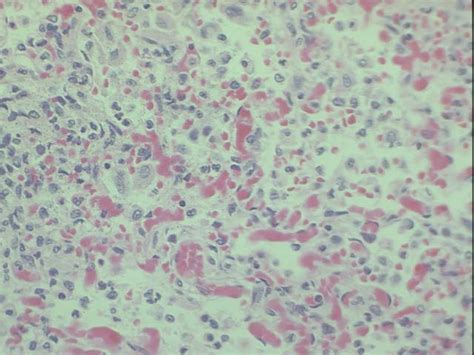 Section Of Averial S Lung H E X Showing Hyaline Membranes In