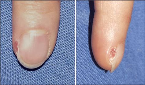 The Tender Growing Subungual Lesion And The Distorted Nail Plate The