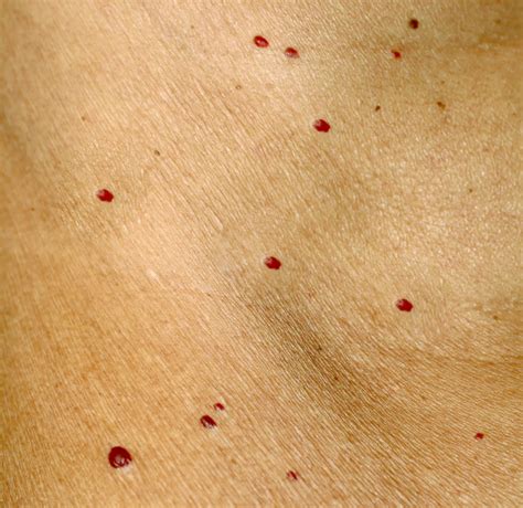 Red Dots On Skin 19 Causes Some Serious Scary Symptoms