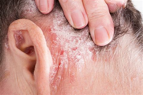 Plaque Psoriasis Causes Side Effects And Treatments At