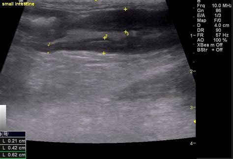 Diagnosing Gi Lymphoma With Ultrasound