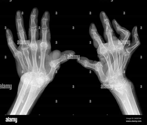Rheumatoid Arthritis Of The Hands Bilateral X Rays Of The Hands And