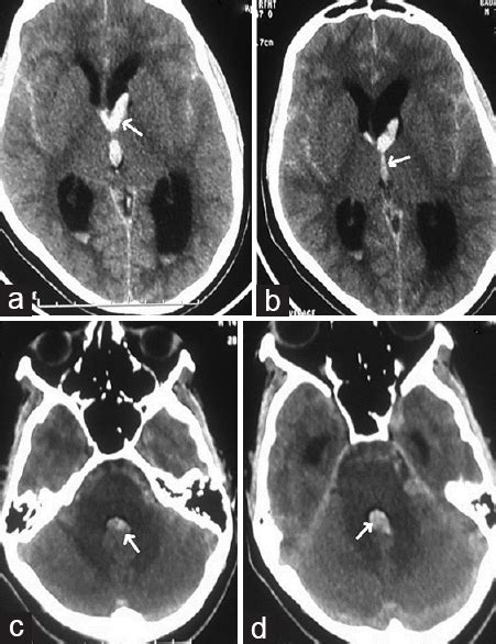 Intracranial Pial Arteriovenous Fistulae Diagnosis And Treatment