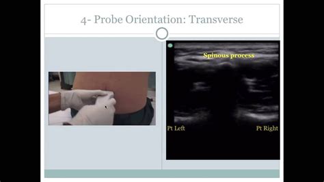 Ultrasound Guided Lumbar Puncture Youtube