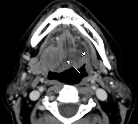 Do Radiologists Report The Tnm Staging In Radiology Reports For Head