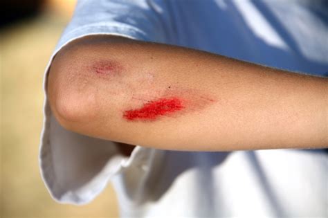 How To Stop Bleeding In A Pinch Die Hard Survivor
