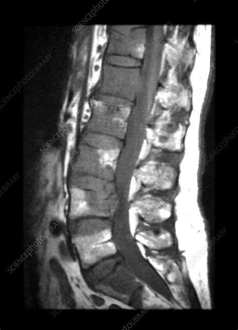 Mri Metastatic Lung Cancer To Lumbar Spine Stock Image C0430313