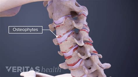 Cervical Osteophytes Treatment Options Spine Health