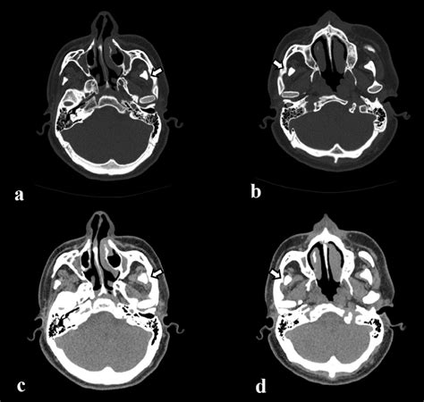 Axial Ct In 2 Views Soft Tissue Window A And B And Bone Window C