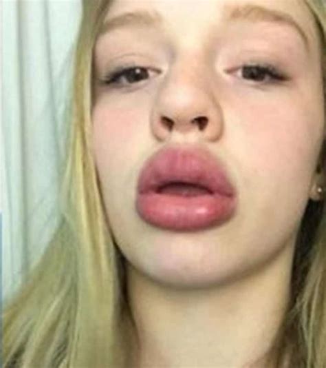 Reasons Why You Shouldnt Try The Kylie Jenner Lip Challenge Look