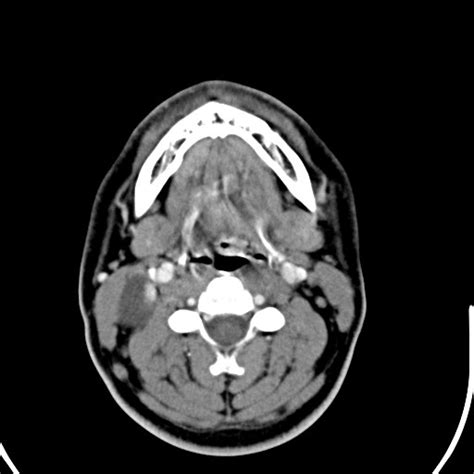 Ct Axial Neck Radrounds Radiology Network