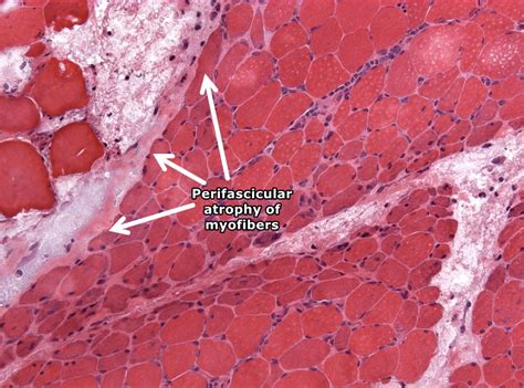 Polymyositis And Dermatomyositis Pathophysiology Wikidoc