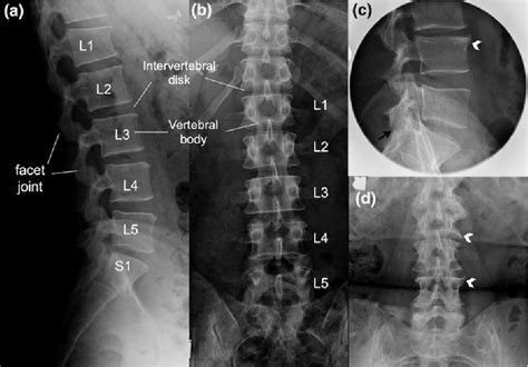 Figure 1 From 2 Osteoarthritis 2 1 Cervical And Lumbar Spondylosis