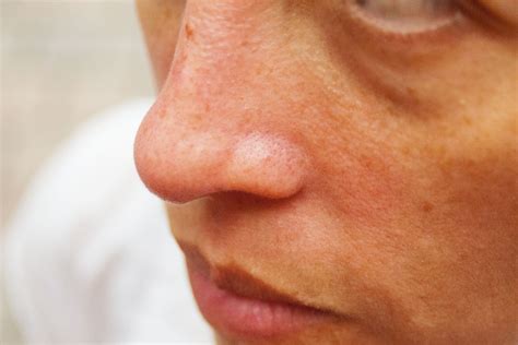 How To Get Rid Of Red On The Side Of The Nose Healthy Living