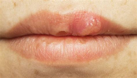 Contratista Demanda Zapatilla Herpes Labial Encias Inflamadas Expulsar