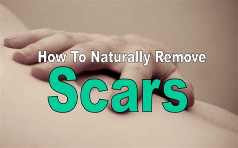Remove Scars Naturally With These 9 Remedies