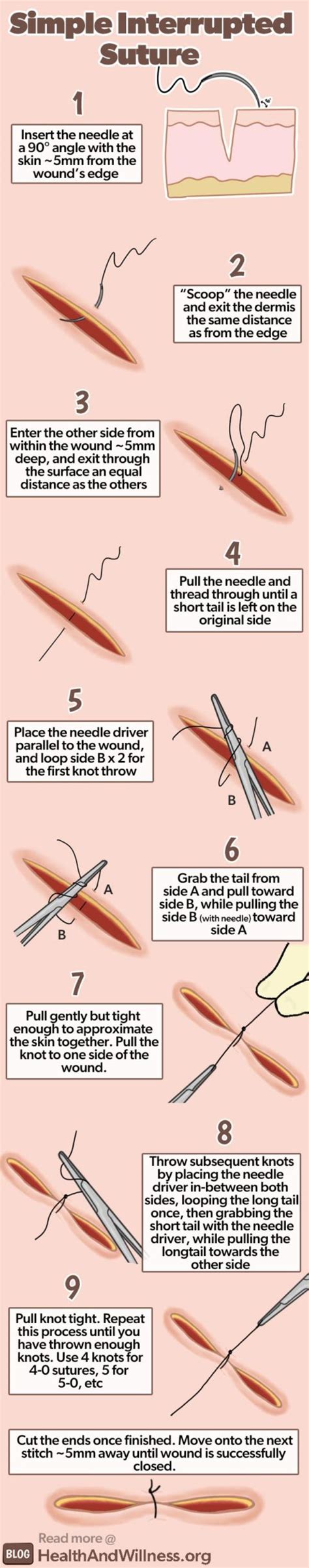 How To Suture Simple Laceration Repair Health And Willness