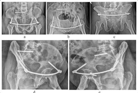 Postoperative Images Of Case 1 A Pelvic Anteroposterior X Ray Image