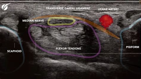 Introduction Of Carpal Tunnel Release Ctr With Ultrasound Guidance