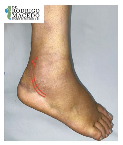 Tendinite Dos Fibulares Dr Rodrigo Macedo Ortopedista