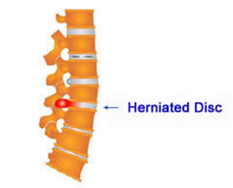 Your herniated disc surgery costs should be covered by your insurance, since herniated disc surgery treats a medical problem. Low Cost Herniated Disc Surgery in India | Affordable Herniated Disc Surgery