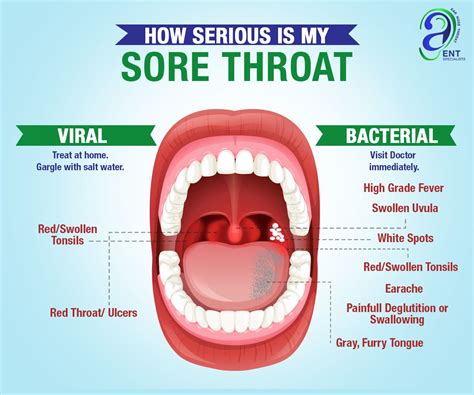 Viral Inflamed Tonsils