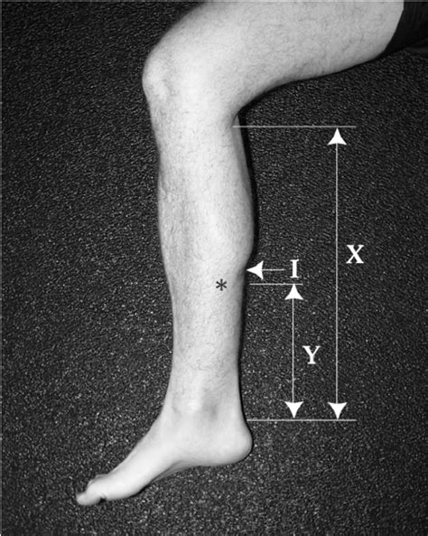 Gastrocnemius Indentation • Due To The Muscle Belly Merging Into The