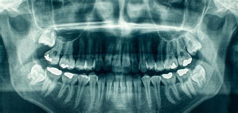 A Importância Da Radiografia Panorâmica Na Odontologia