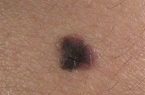 Stage 1 Melanoma Pictures 54 Photos And Images
