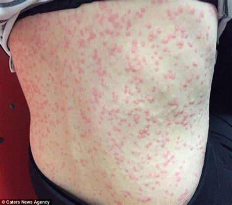 The Mother Who Could Be Killed By Cold Weather Allergic Reaction Means