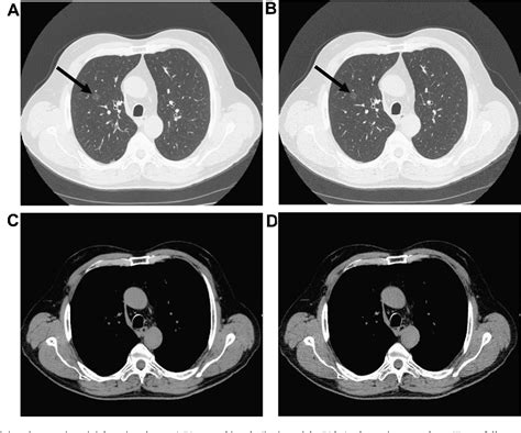 Figure From Low Dose Chest CT Protocol MAs As A Routine Protocol For Comprehensive