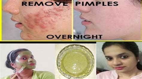 how to remove your pimple overnight diy facepack tips and tricks to follow 😉 youtube