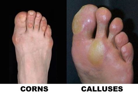 Corns And Calluses Dr7 Physiotherapy Podiatry Hydrotherapy Massage