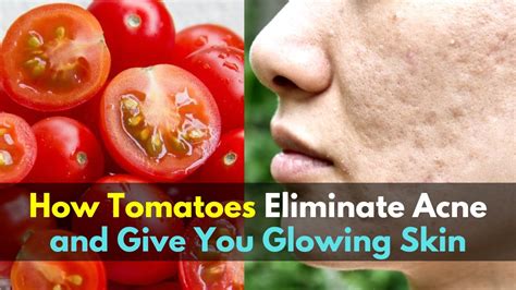 How Tomatoes Eliminate Acne And Give You Glowing Skin Youtube