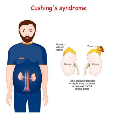 Cushing Syndrome Everything You Need To Know Repc