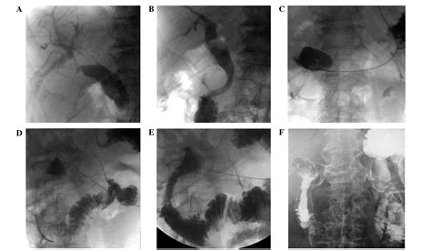 Palliation Double Stenting For Malignant Biliary And Duodenal Obstruction