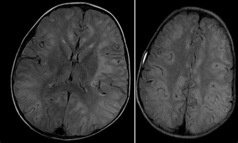 Brain Mri In Flair Sequence Shows Extensive Symmetric And Bilateral