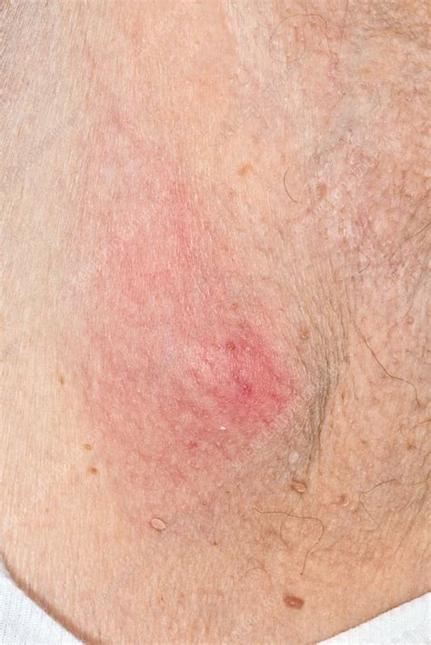 Infected Sebaceous Cyst Stock Image C0269163 Science Photo Library