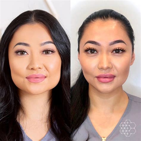 Facial Slimming Vancouver Bc Non Surgical Jawline Treatment