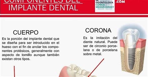 Odontolog A Cl Nica Moguillansky Implantes Dentales Y Rehabilitaci N