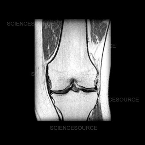 Photograph Mri Of Knee With Osteoarthritis Science Source Images
