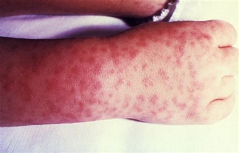 Epidemic And Murine Typhus Lice Fleas And Bacteria Healdove