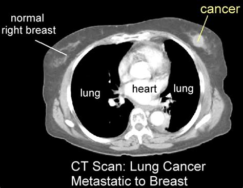 Chest Ct Scan Show Breast Cancer Ct Scan Machine