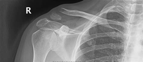 Clavicle Fractures Core Em